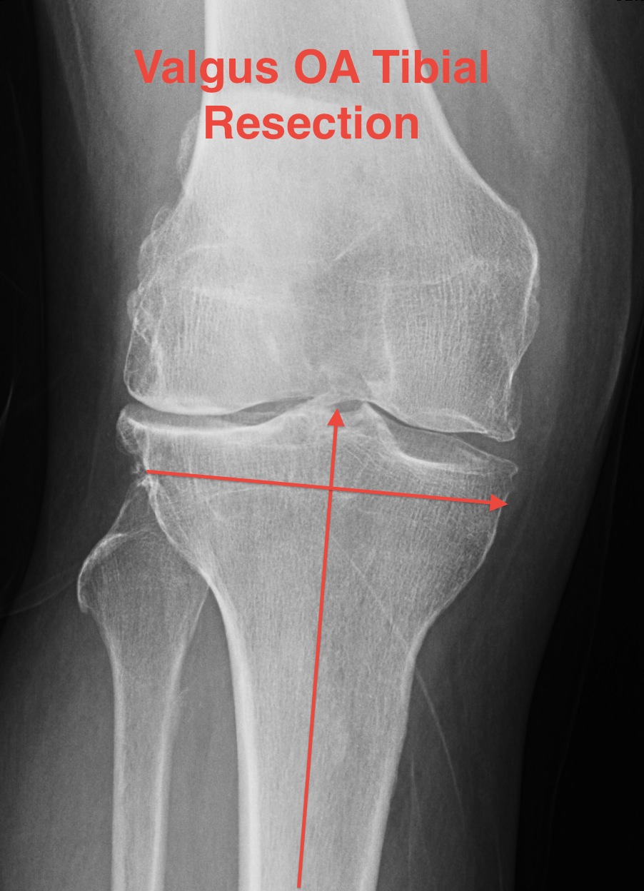 TKR Valgus OA Tibial Resection